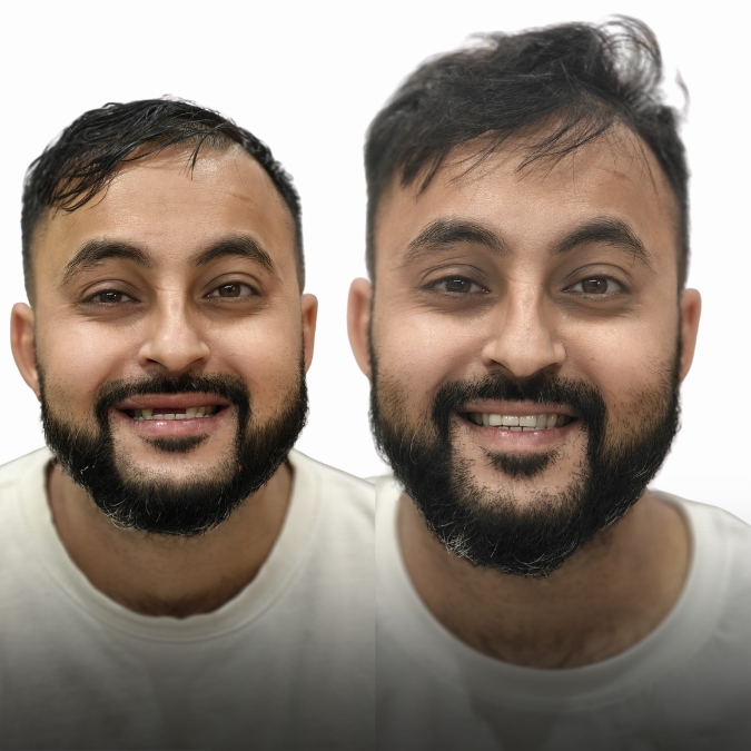Smile Makeover - Case 3