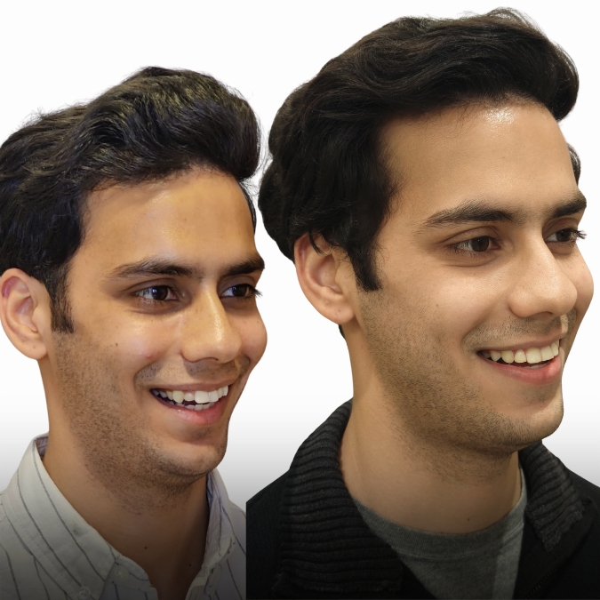 Smile Makeover - Case 2
