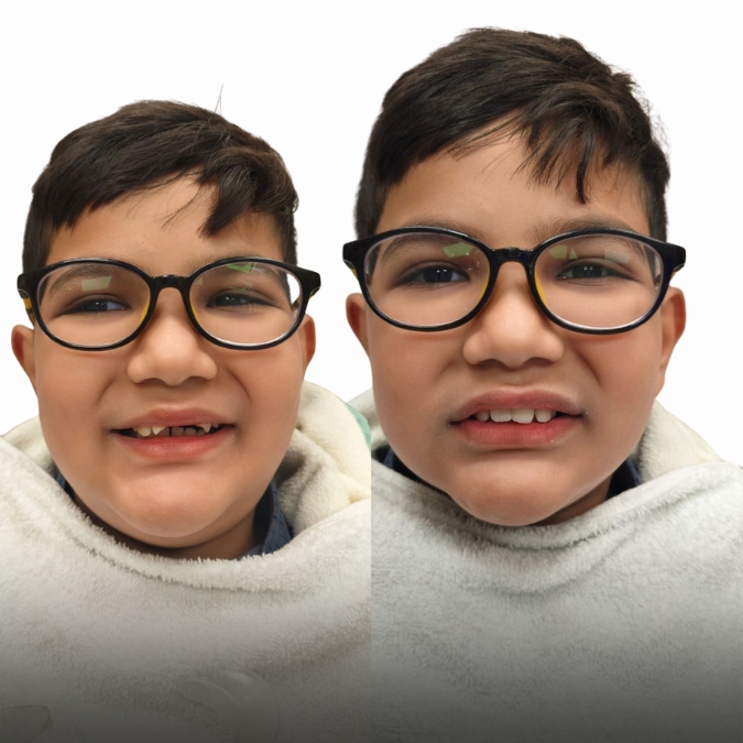 Smile Makeover - Case 1