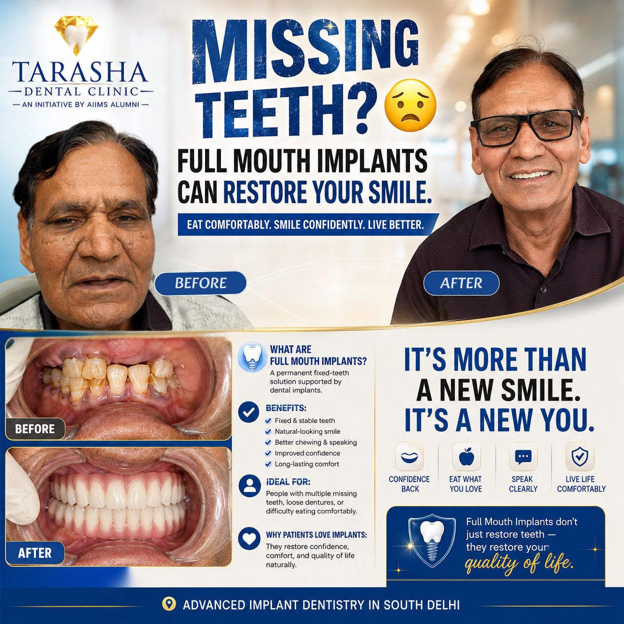 Full Mouth Implants in Delhi by AIIMS alumni dentists