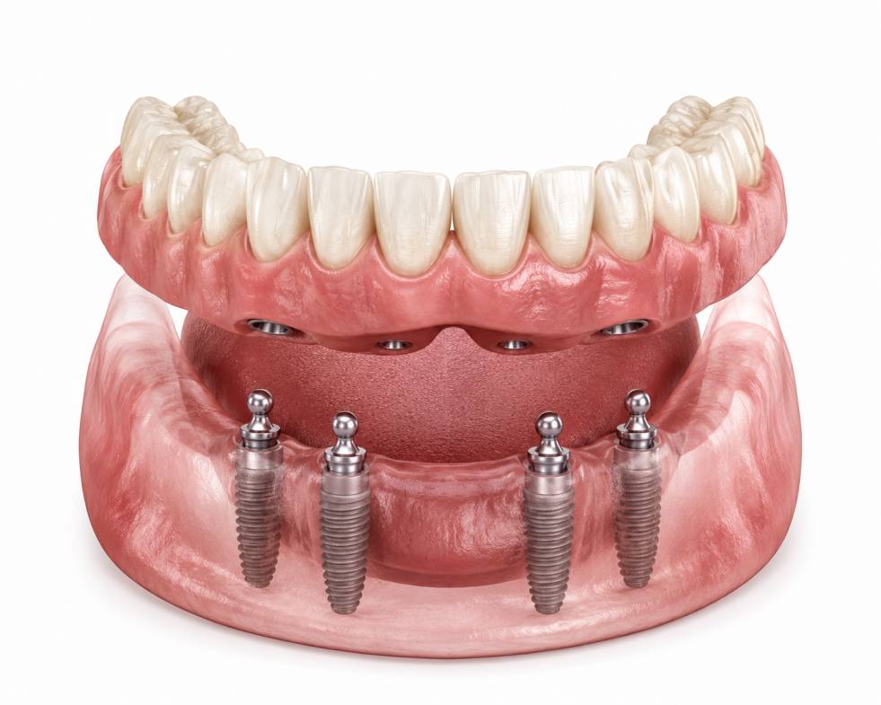 Secure implant retained dentures Lajpat Nagar Delhi consultation