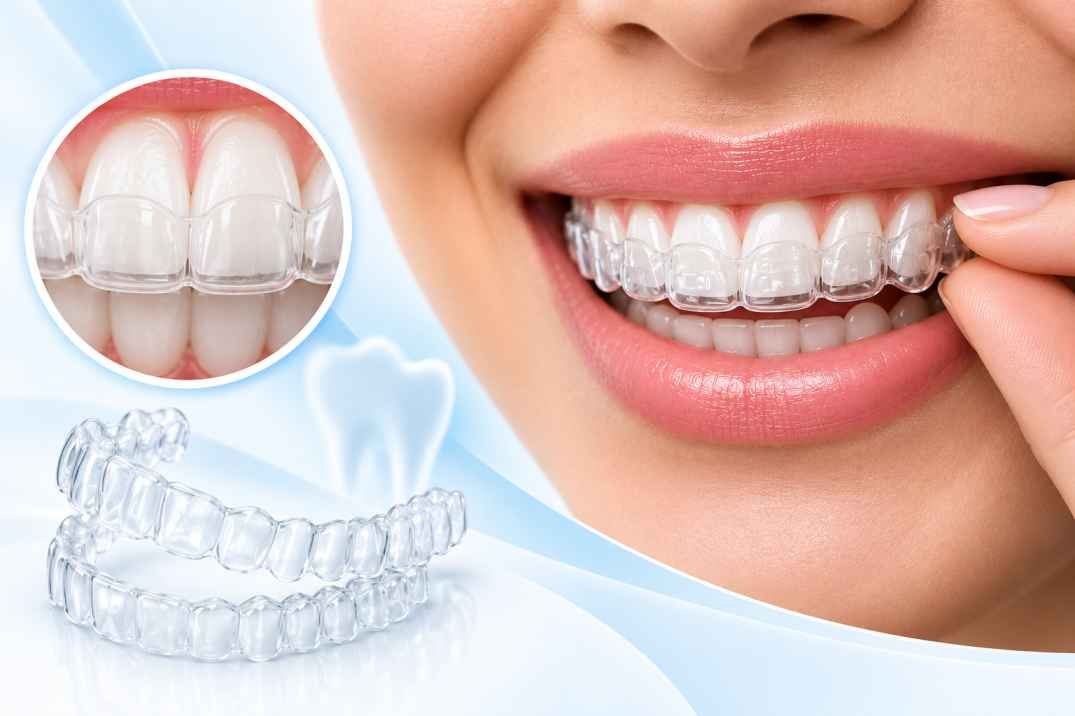 Invisible clear aligners treatment in Delhi at Tarasha Dental Clinic Lajpat Nagar