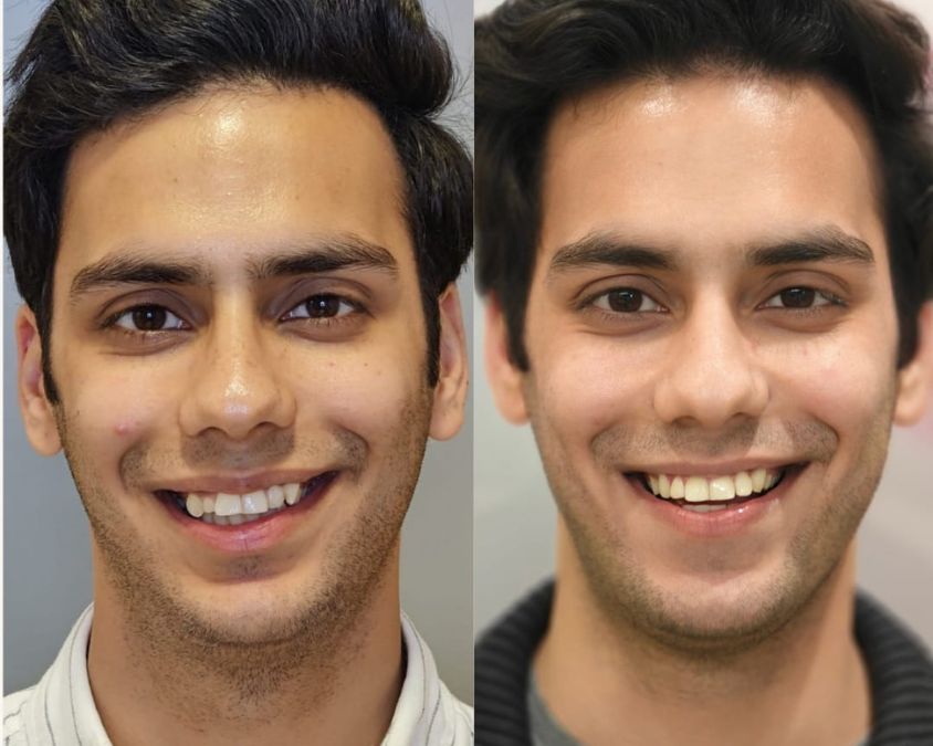 Braces and aligners