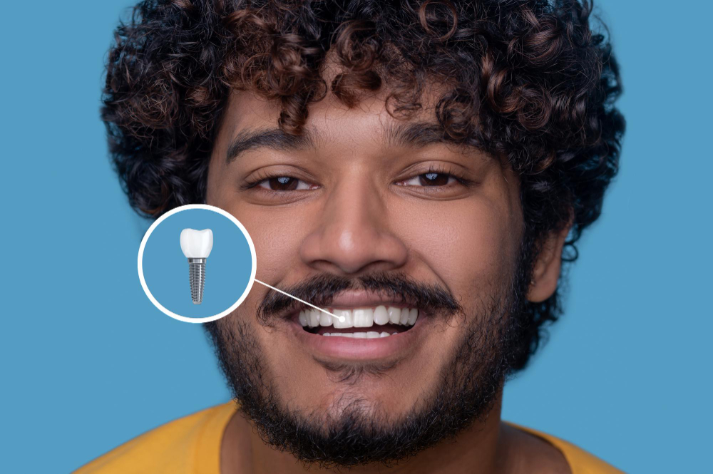 Single Tooth Implant