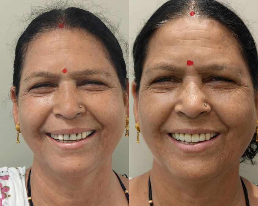 Smile designing post